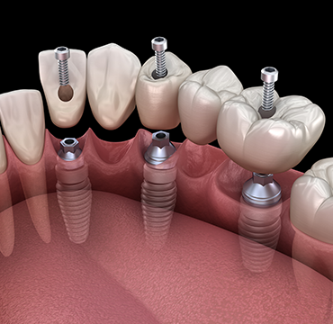 DENTAL IMPLANTS at Pearlline Multispeciality Dentocare the
                                best dental clinic in Hosur